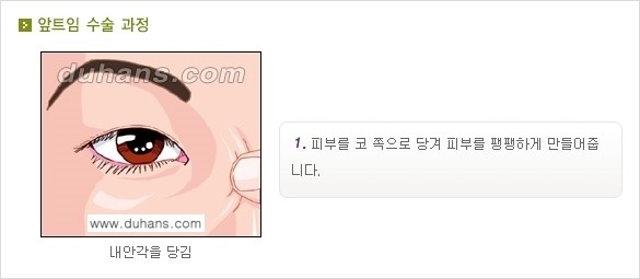 [두한성형외과 NO.1 눈성형] - [몽고주름 제거(앞트임 수술) 2.] 관련 이미지 2