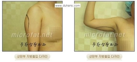 [두한성형외과 경쟁력 바디성형] - [복부, 옆구리, 허벅지, 엉덩이, 팔뚝, 종아리 간편지방흡입술 안내] 관련 이미지 6