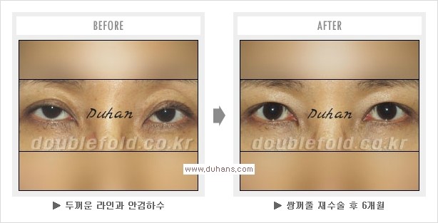 [두한성형외과 경쟁력 쌍꺼풀 재수술, 극한 눈재수술] - [과교정 된 눈매교정] 관련 이미지 7