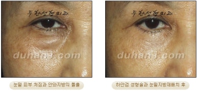 Blepharoplasty, Duhan Plastic Surgery - Upper and Lower Eyelids image 24