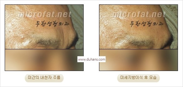 [두한성형외과 경쟁력 주름성형] - [미세지방이식을 이용한 미간주름 제거 효과] 관련 이미지 6