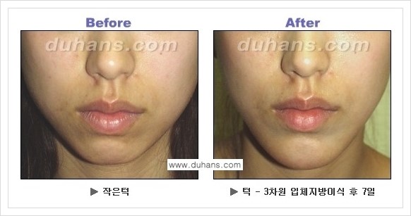 [두한성형외과 경쟁력 미세지방이식] - [아름다운 얼굴선 - 무턱, 오목턱, 비대칭턱 지방이식 안내] 관련 이미지 10