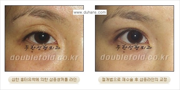 ⁠[두한성형외과 경쟁력 쌍꺼풀 재수술, 극한 눈재수술] - [삼중(세겹) 쌍꺼풀 라인의 교정] 관련 이미지 5