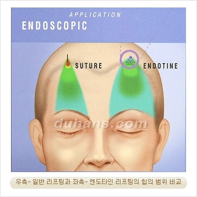 [Duhan Plastic Surgery Wrinkle Surgery] - [Endotine Lifting for Wrinkle Improvement] image 16