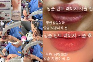 입술 지방이식, 색깔개선 레이저 후기 입니다~! 관련 이미지 1