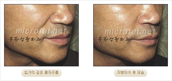[두한성형외과 경쟁력 안티에이징 동안성형] - [주름이 깊은 푹~ 꺼진 입가 팔자주름 안녕!] 관련 이미지 28