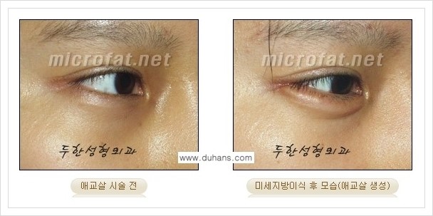 [두한성형외과 경쟁력 눈밑성형] - [눈밑 애교살 미세지방이식 안내] 관련 이미지 9