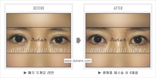[두한성형외과 경쟁력 쌍꺼풀 재수술, 극한 재수술] - [쌍꺼풀 재수술로 인해 흉살이 두터운 경우] 관련 이미지 6