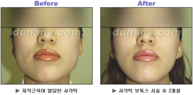 [Duhan Plastic Surgery Clinic Aesthetic Procedures] - [Square Jaw Botox] image 24