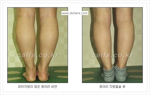[두한성형외과 경쟁력 멀티종아리성형] - [정교한 미세흡입관 종아리 지방흡입술] 관련 이미지 8