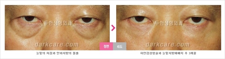 ​[두한성형외과 경쟁력 눈밑성형 리더] - [눈밑 다크써클의 증상, 원인, 종류, 치료방법 안내] 관련 이미지 59