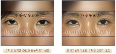 [두한성형외과 쌍커풀수술] - [쌍꺼풀지방이식] 관련 이미지 24