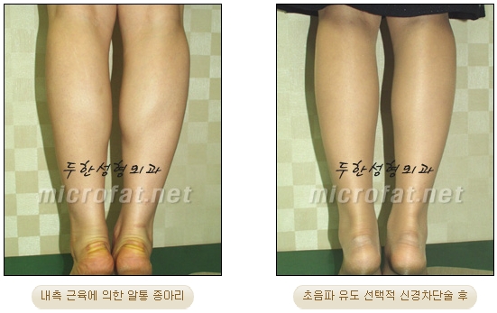 [Duhan Plastic Surgery Clinic Calf Contouring] - [Calf Reduction] image 19