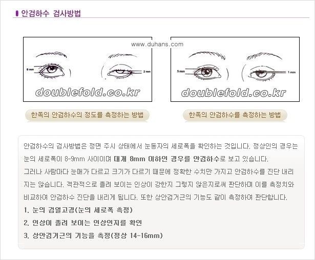 [두한성형외과 경쟁력 눈성형] - [안검하수(졸린 눈매) 재수술 안내 ②] 관련 이미지 3