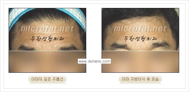 [두한성형외과 경쟁력 미세지방이식] - [부드럽고 아름다운 얼굴 윤곽선 이마(전두부) 미세지방이식] 관련 이미지 12