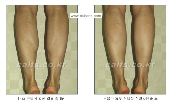 [두한성형외과 경쟁력 종아리성형] - [초음파 유도 선택적 신경차단술 안내 ③] 관련 이미지 13