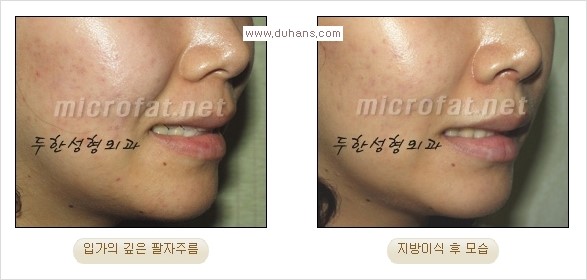 [두한성형외과 경쟁력 주름성형] - [코 옆과 입가에 걸쳐서 형성된 주름을 교정해주는 미세지방이식] 관련 이미지 9