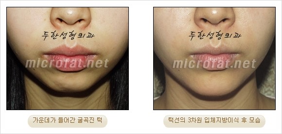[두한성형외과 경쟁력 지방이식 리더] - [Col-fat(콜펫)지방이식, 3차원 입체지방이식, 2차원 평면지방이식] 관련 이미지 40