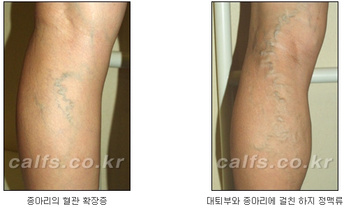 ​[두한성형외과 종아리수술] - [나에게 맞는 종아리성형방법] 관련 이미지 39