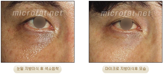 [두한성형외과 지방이식] - [타병원의 지방이식 부작용 교정] 관련 이미지 35