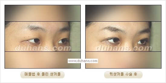 ​[두한성형외과 경쟁력 눈성형] - [자연스럽고 아름다운 쌍꺼풀의 기준] 관련 이미지 18