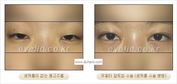 [두한성형외과 경쟁력 눈성형] - [흉터없는 몽고주름 제거 - 앞트임 수술] 관련 이미지 13
