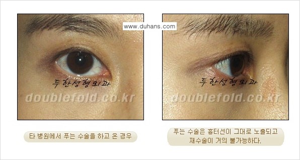​[두한성형외과 쌍꺼풀 재수술] - [푸는 수술을 하고 내원했을 경우의 문제] 관련 이미지 1