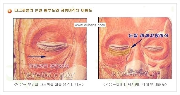 [두한성형외과 경쟁력 눈밑성형] - [다크써클 수술 안내 2.] 관련 이미지 2
