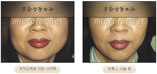 [두한성형외과 보톡스] - [사각턱 보톡스 시술 안내] 관련 이미지 20