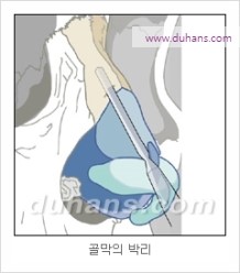 [두한성형외과 경쟁력 코성형 리더] - [자연스럽고 오똑한 콧망울! 코성형 방법]​ 관련 이미지 6