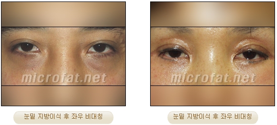 [두한성형외과 지방이식] - [지방이식 부작용 종류와 문제점] 관련 이미지 6