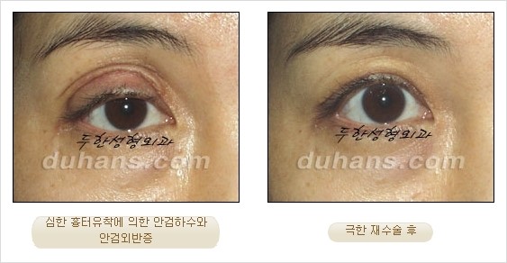 [두한성형외과 경쟁력 쌍꺼풀 재수술 리더 ] - [쌍꺼풀 재수술 과정, 쌍꺼풀 재수술 실패의 원인, 극한 재수술] 관련 이미지 8