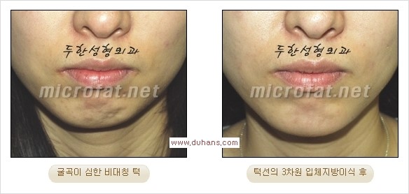 [두한성형외과 경쟁력 미세지방이식] - [부드럽고 아름다운 얼굴윤곽선 턱(하악부) 미세지방이식 안내] 관련 이미지 23