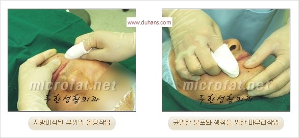 [두한성형외과 경쟁력 미세지방이식] - [타 병원의 지방이식 부작용 교정 - 정교한 마이크로 지방이식, 흡입 안내] 관련 이미지 30
