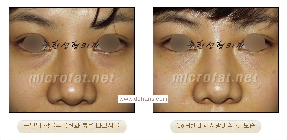 [두한성형외과 경쟁력 눈밑성형] - [눈밑이 전반적으로 함몰된 다크써클 교정 안내] 관련 이미지 11