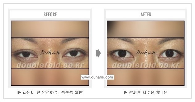 [두한성형외과 경쟁력 쌍꺼풀 재수술] - [여러번의 쌍꺼풀 재수술로 인한 흉살이 두터운 경우 안내] 관련 이미지 3