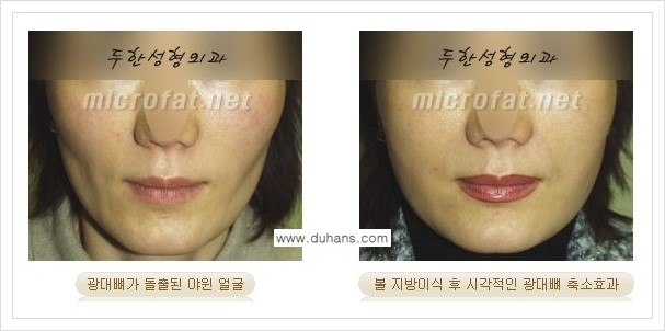 ⁠⁠[두한성형외과 경쟁력 볼살지방이식] - [심하게 야윈 주름이 있는 얼굴, 역삼각형 협소한 얼굴, 광대뼈가 돌출되어 보이는 경우 안내] 관련 이미지 17