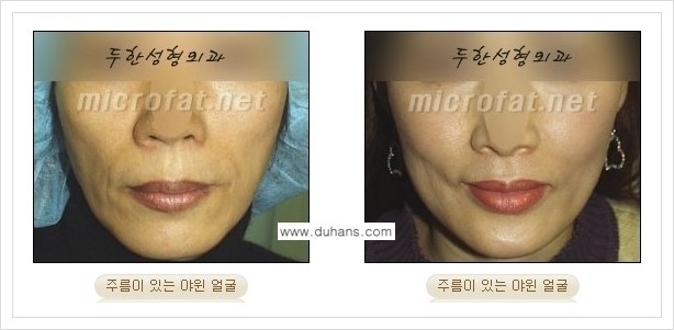 ⁠⁠[두한성형외과 경쟁력 볼살지방이식] - [심하게 야윈 주름이 있는 얼굴, 역삼각형 협소한 얼굴, 광대뼈가 돌출되어 보이는 경우 안내] 관련 이미지 2