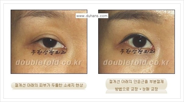 [두한성형외과 경쟁력 쌍꺼풀 재수술, 극한 재수술] - [절개선 아래가 두툼한 소세지 쌍꺼풀의 교정 안내] 관련 이미지 5