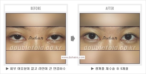 [두한성형외과 쌍꺼풀 재수술, 극한 눈재수술] - [재수술에 대한 자주하는 질문과 답변 안내] 관련 이미지 1