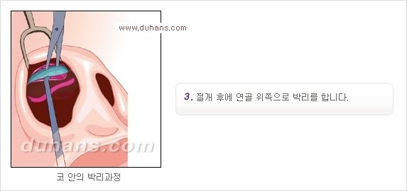 [두한성형외과 경쟁력 코성형] - [코성형을 위한 알로덤(슈어덤) 수술, 실리콘 수술 안내] 관련 이미지 21
