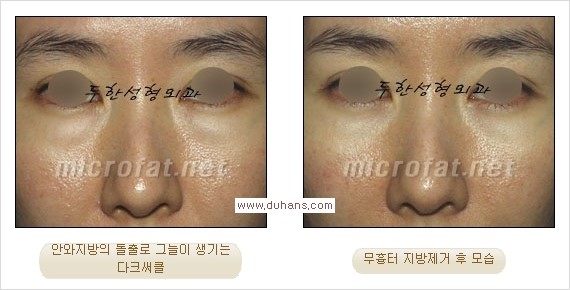 [두한성형외과 경쟁력 눈밑성형] - [과도한 눈밑지방제거의 부작용 후 눈밑지방재배치] 관련 이미지 16