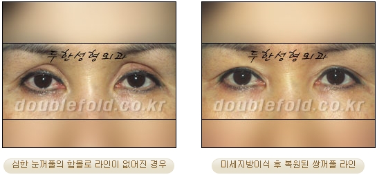 [두한성형외과 눈재수술] - [지방이식과 쌍꺼풀재수술 동시에 하는 경우] 관련 이미지 30