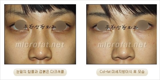 ​[두한성형외과 경쟁력 눈밑성형 리더] - [눈밑 다크써클의 증상, 원인, 종류, 치료방법 안내] 관련 이미지 42