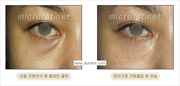 ​​​​[두한성형외과 경쟁력 미세지방이식] - [지방이식 부작용 - 지방이식 과다주입, 과다생착의 얼굴 모양에 대한 안내] 관련 이미지 8