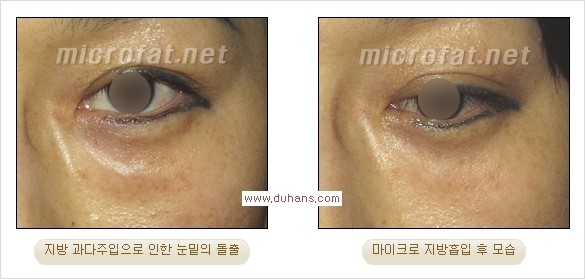 ​[두한성형외과 경쟁력 지방이식] - [지방이식 부작용 이후 마이크로 지방흡입, 마이크로 지방흡입 이후 부작용 없는 지방이식 방법] 관련 이미지 8