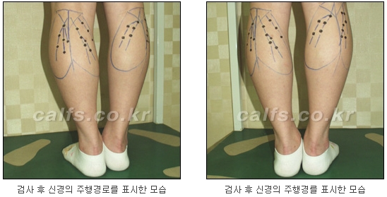 [두한성형외과 종아리퇴축술] - [NO절개! 초음파유도신경차단술] 관련 이미지 10