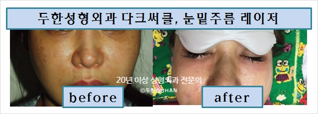 두한성형외과 안티에이징 리프팅 - 엔도타인 리프팅 관련 이미지 43