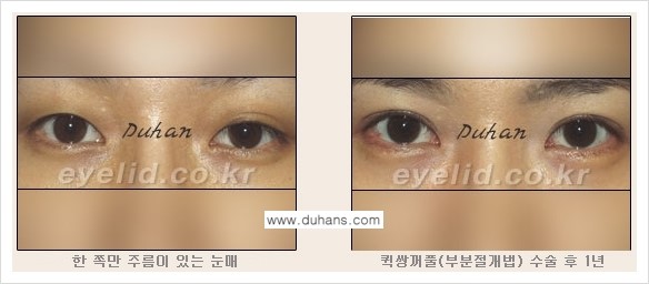 [두한성형외과 NO.1 눈성형] - [절개법과 매몰법 관련 흔한 질문과 답변] 관련 이미지 4
