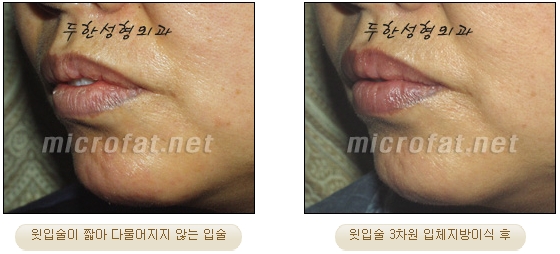 [Duhan Plastic Surgery Lip Surgery] - [Lip Correction Fat Grafting] image 24